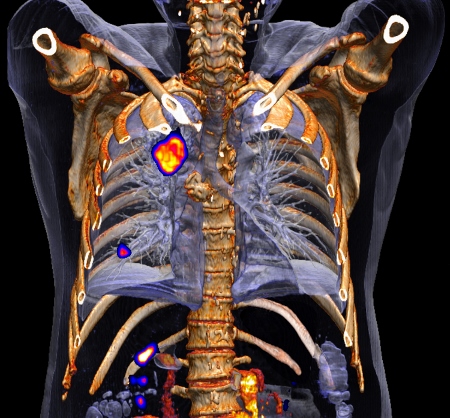 A\'bold new era\' as Siemens launches ground-breaking PET-CT system