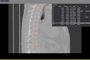 AI service detects vertebral fractures in more than 2,000 NHS patients 