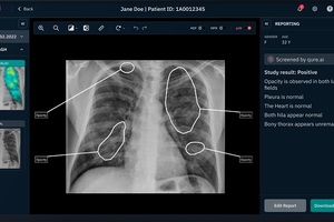 AI software helps speed up X-ray reporting
