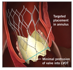 Approval for next-generation treatment for high-risk aortic stenosis patients