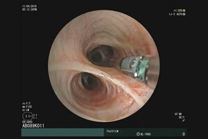 Aquilant launches bronchoscopy range