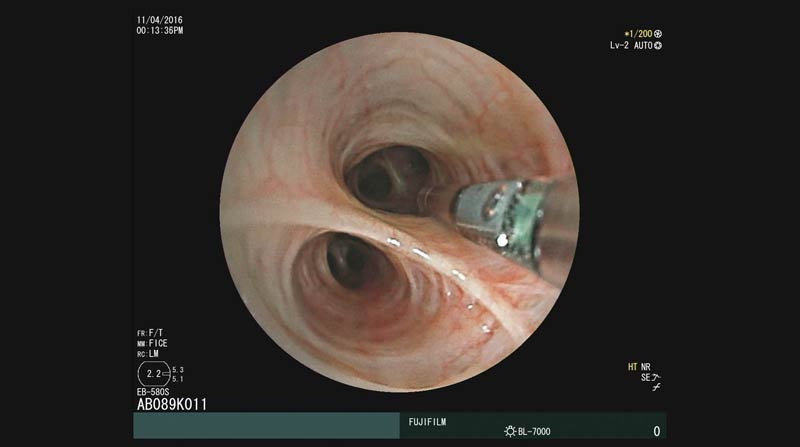 Aquilant launches bronchoscopy range