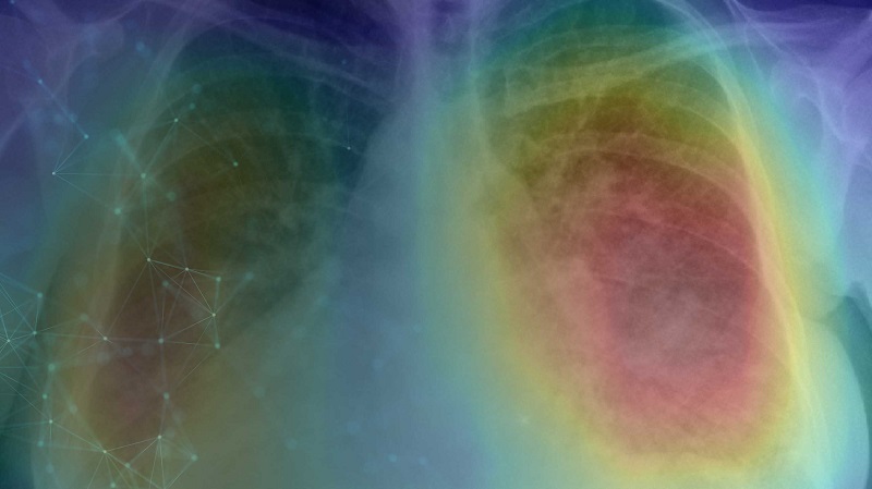 Among the recipients is BeholdAI, which will use the money to further develop its AI algorithm which can identify suspected lung cancer in chest X-rays