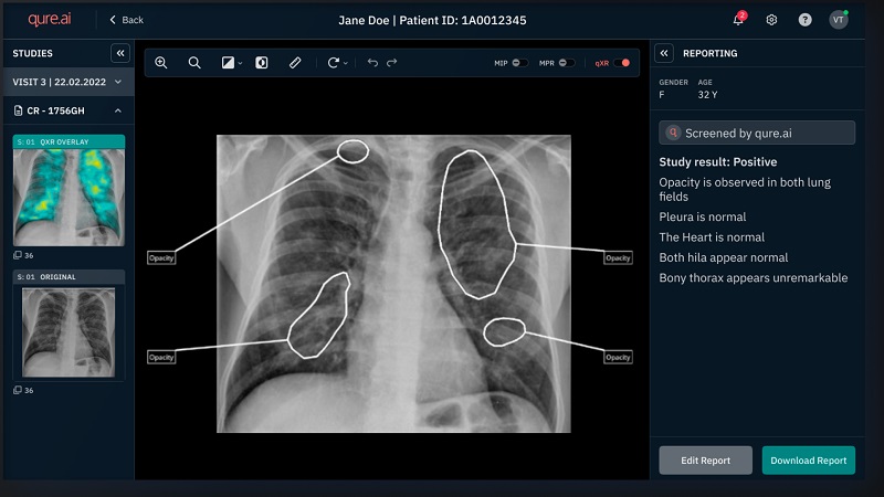 Qure.ai's AI software can help to check chest X-rays, reducing pressure on clinical staff