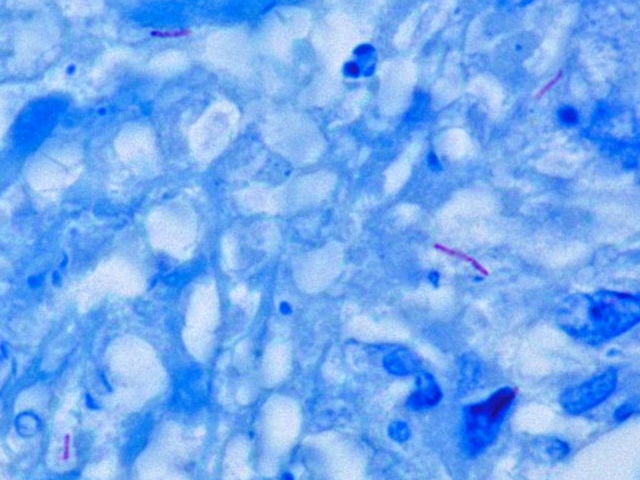 Mycobacterium tuberculosis Ziehl-Neelsen stain