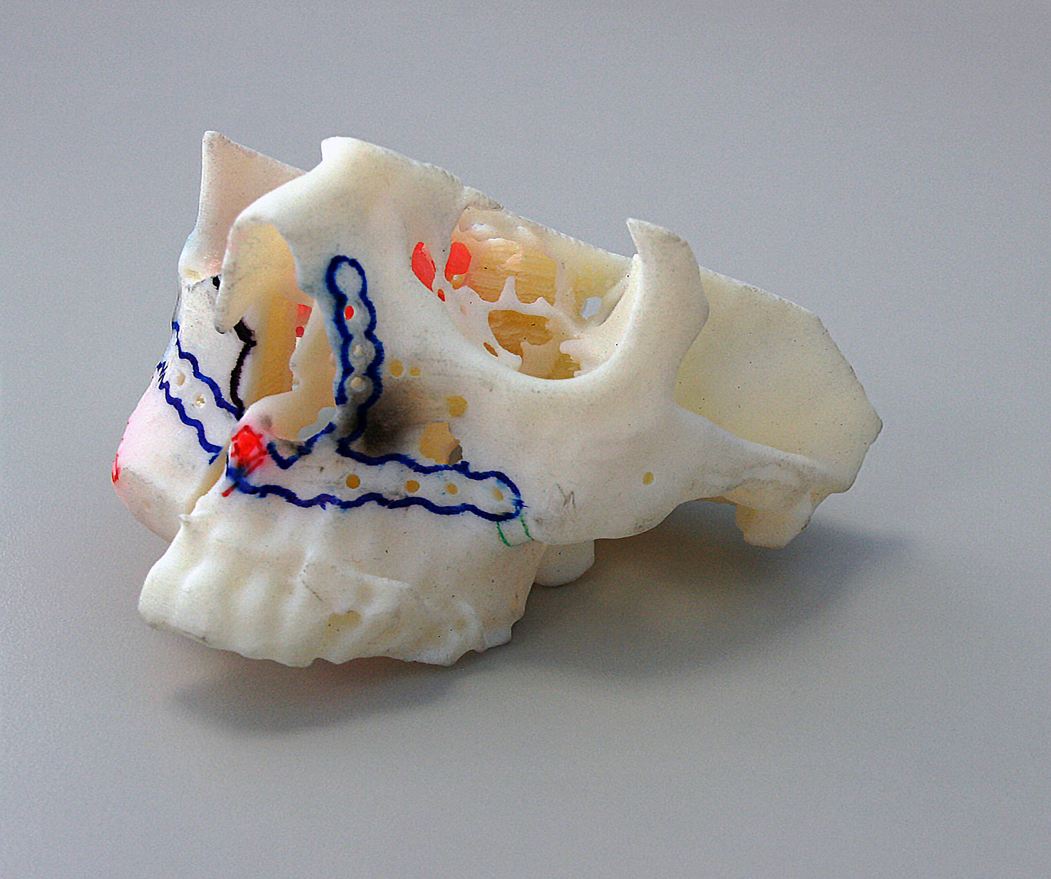 The in-house Stratasys 3D Printer enables the creation of exact replicas of the patient’s anatomy and allows customised fittings and pre-bending of plates