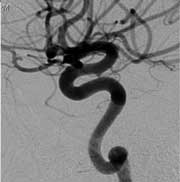An aneurysm six months after treatment with the Pipeline technology