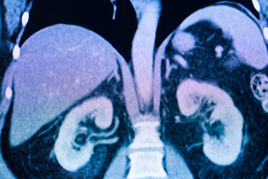 Artificial intelligence tool predicts kidney failure six times faster than doctors