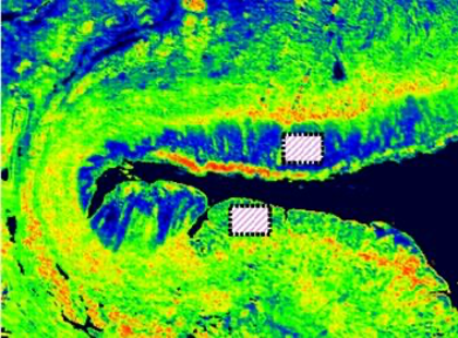 Breast cancer diagnostic tool could save the NHS £287m