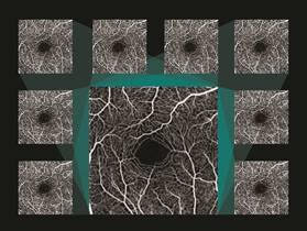 Canon redesigns OCT averaging technology to better visualise retinal disease