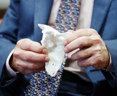 Case study: Instant surgical planning with low-cost 3D printed bone models