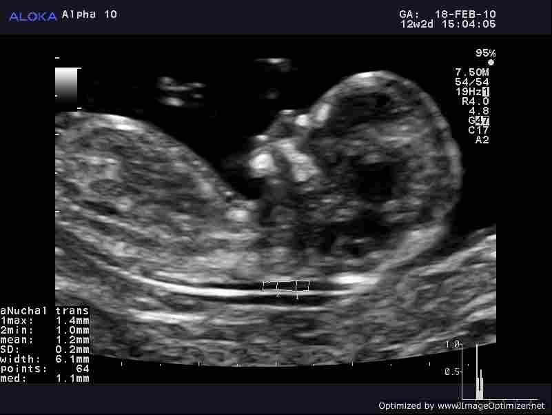 COMMENT: The impact of automatic nuchal translucency measurement to detect Down’s Syndrome