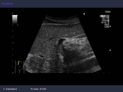 COMMENT: Ultrasound provides hope for hepatic cancer patients