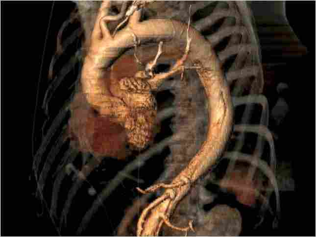 COMMENT: Vascular surgeon, Matt Thompson, on the importance of research and development in aortic dissection