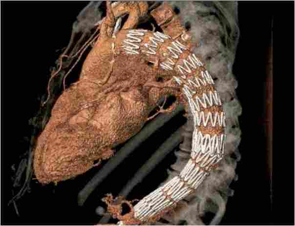 COMMENT: Vascular surgeon, Matt Thompson, on the importance of research and development in aortic dissection
