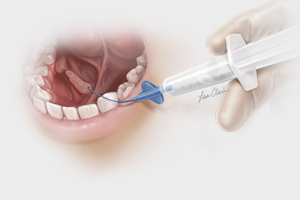 Cook Medical launches SialoCath salivary duct catheter