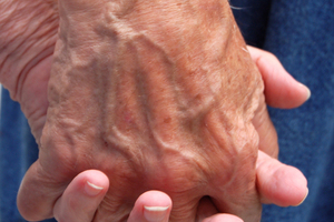 Dementia hubs plan for Scotland