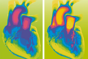 Diagnosing heart failure with bioMérieux’s VIDAS Galectin-3 