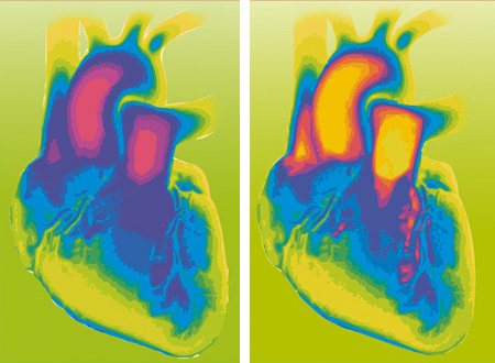 Diagnosing heart failure with bioMérieux’s VIDAS Galectin-3 