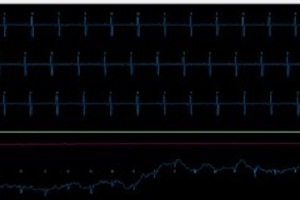 Dramatic cut in waiting times for hospitals trialling AI heart monitoring technology