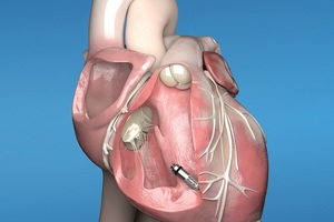 Glenfield Hospital first to implant world’s-smallest leadless pacemaker 