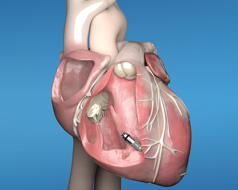 Glenfield Hospital first to implant world’s-smallest leadless pacemaker 