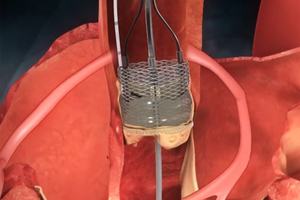 Ground-breaking new cardiac implant fitted for first time by UK medics