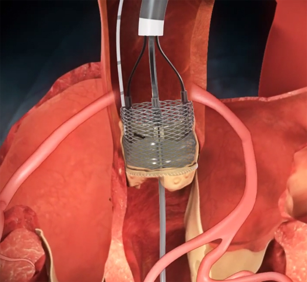 Ground-breaking new cardiac implant fitted for first time by UK medics