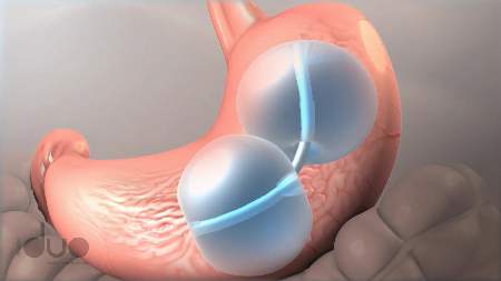 Groundbreaking balloon could solve UK obesity crisis 