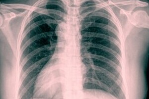 Improving indoor air quality to reduce the risk of Aspergillus infection