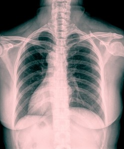 Improving indoor air quality to reduce the risk of Aspergillus infection