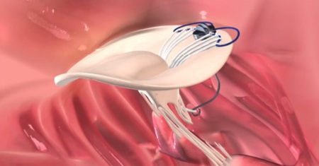 Investment grant to develop first transvascular mitral valve implant