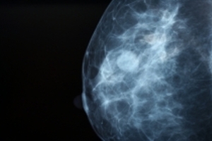 Kromek awarded three-year project to deliver molecular breast imaging device