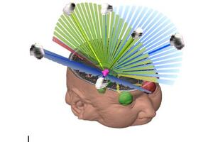 Latest advancement in radiosurgery marks opportunity to expand the use of SRS to various tumour types