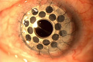 Latest NICE Medical Innovation Briefings published