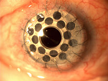 Latest NICE Medical Innovation Briefings published
