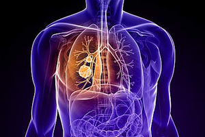 Major milestone met in AI-powered fight against lung cancer
