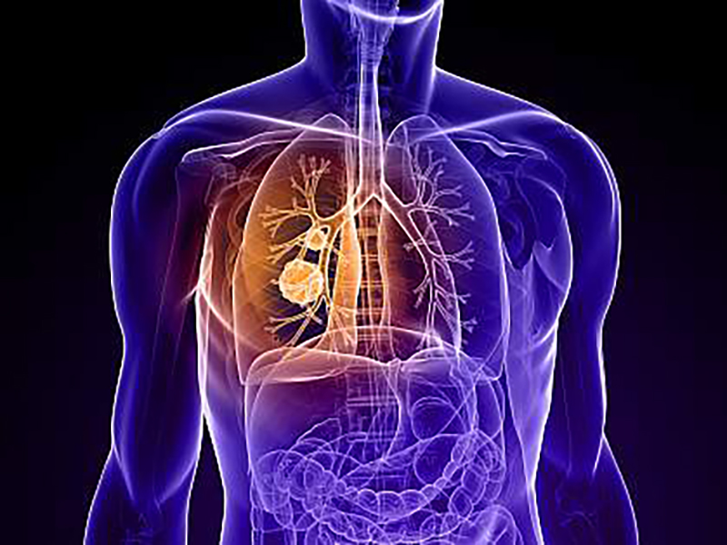 Major milestone met in AI-powered fight against lung cancer