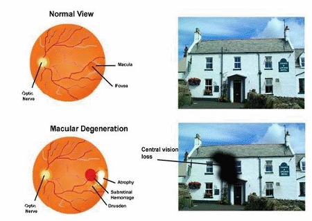Nanosecond laser could provide cure for blindness