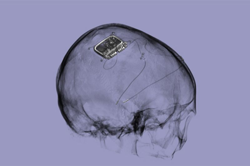 New £50m research centre to advance brain stimulation therapies