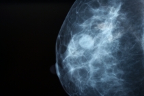 New blood test for the earlier diagnosis of breast cancer spread