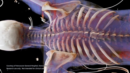New clinical research software from Siemens Healthcare paves the way for innovative CT techniques in the UK