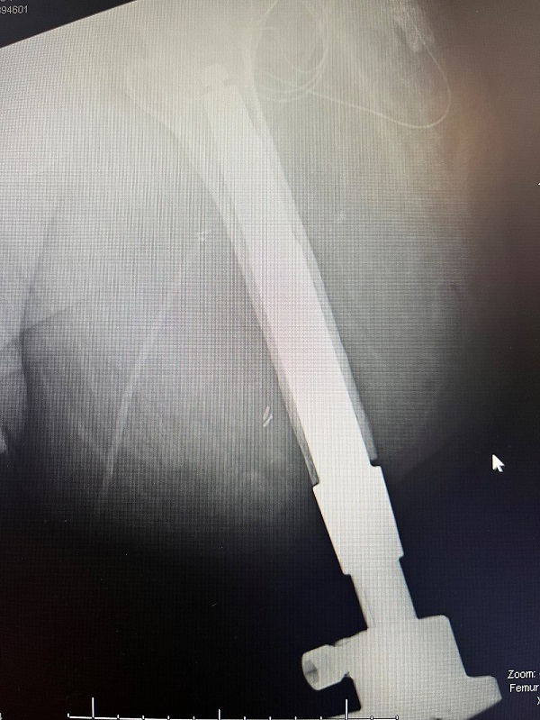 NHS funds first osseointegration surgery at St George Hospital