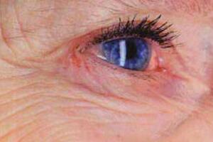 NHS Supply Chain to offer sight-saving retinal scanners across England 