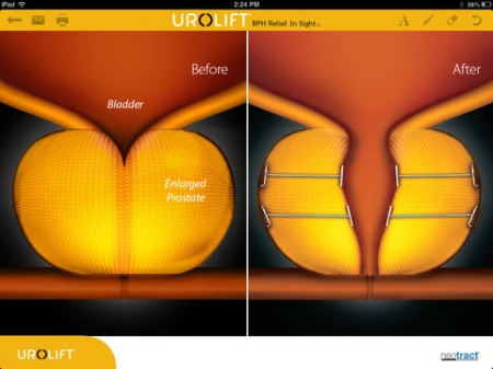 NICE consults on plans to support new device which avoids surgery for enlarged prostate glands
