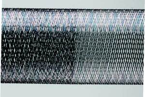NICE recommends embolisation device for treatment of brain aneurysms