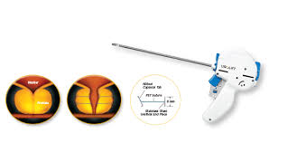 NICE recommends new device which avoids surgery for enlarged prostate glands
