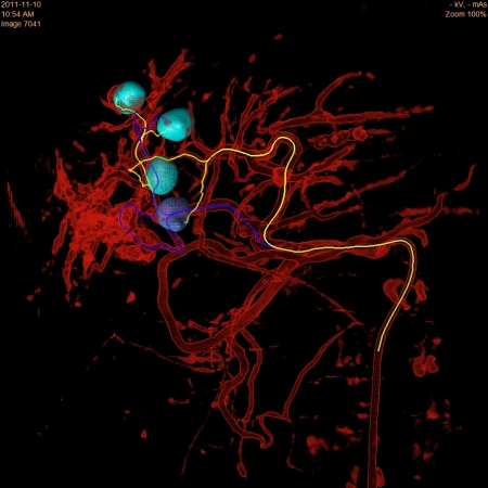 Philips introduces interventional oncology solution for advanced tumour analysis 