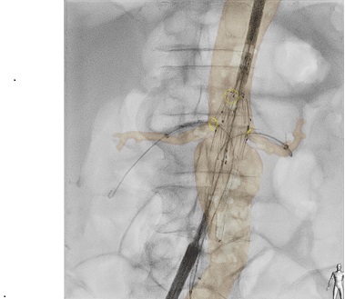 Philips unveils VesselNavigator live 3D catheter navigation guide