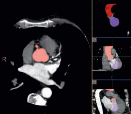 Planning and guidance tool offers lifeline for high-risk cardiac patients